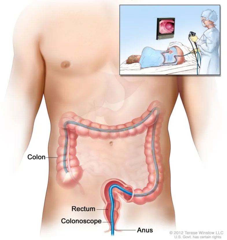 colonoscopy scope