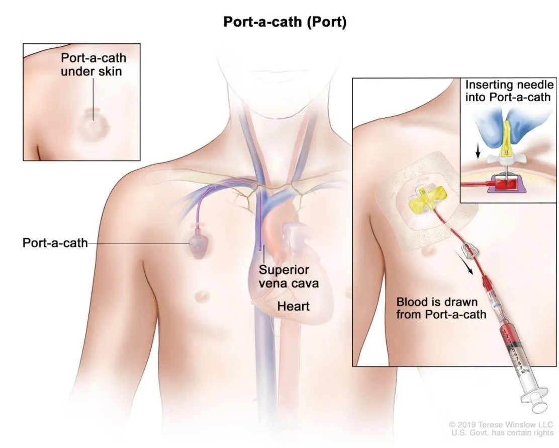 Ports, PICC lines and pumps - Colontown University