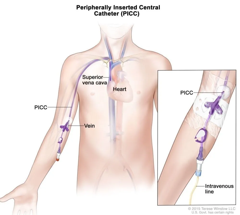 Implanted Chemo Port - An implanted device allowing easy access to the  veins for chemotherapy
